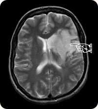 Brain scan of stroke sufferer